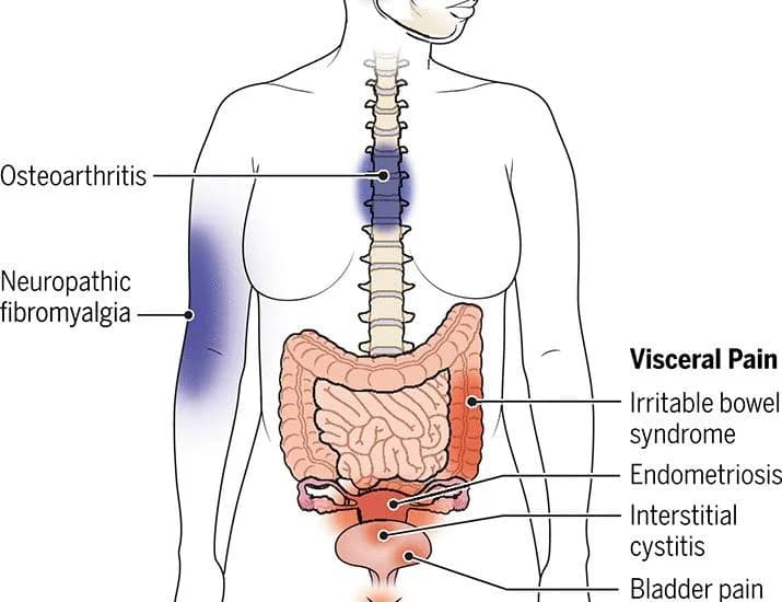 Sex-specific mechanisms of chronic pain | Science